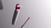 Fixo 4mm