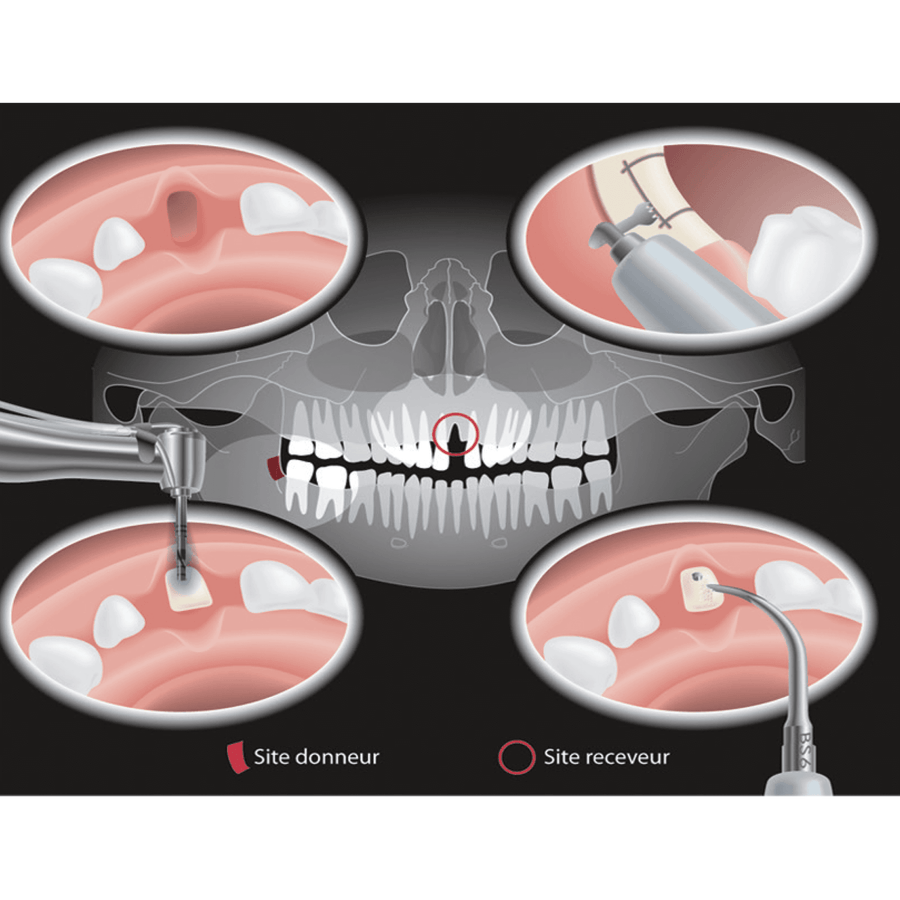 Osteotomy / Osteoplasy Kit. Surgical tips designed for Piezotome®